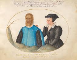 This disorder, which is scientifically known as. Hypertrichosis Wikipedia