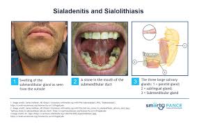 Image result for Sialolithiasis