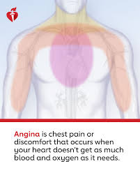 Image result for Angina Pectoris