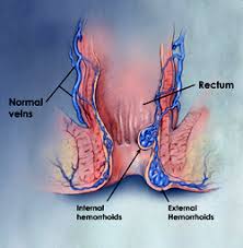 The most important thing is to add fiber to your diet. Hemorrhoids Atlanta Gastroenterology Associates