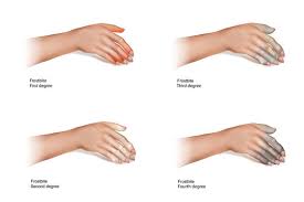 Image result for Frostbite