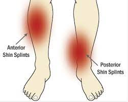 Tape Yourself Shinsplints Shin Splints Shin Splints Treatment Running Injuries