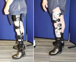 Cumbersome Nhs Leg Calliper Vs Lightweight Carbon Fibre Knee Brace From Technology In Motion Leg Braces Orthotics And Prosthetics Orthosis