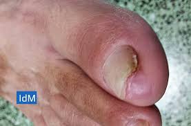 Onicomicosis Guia Completa Causas Sintomas Tratamiento Prevencion
