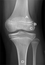 Well, what do you know? Fracture Education Mcq