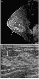 According to breastcancer.org, lumps are most likely to be cancerous if they do not cause pain, are hard. A 39 Year Old Woman With Breast Cancer In Upper Outer Quadrant Of Left Download Scientific Diagram
