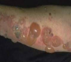 Image result for Pemphigoid