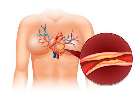 Image result for Angina Pectoris
