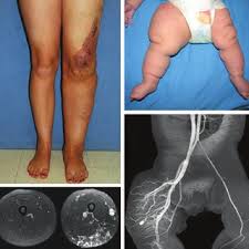 Image result for Pediatric Leg Disorder