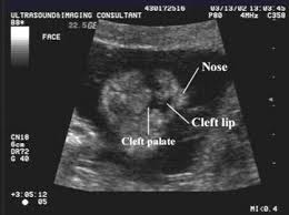 Ultrasound Of Cleft Lip And Palate Ultrasound Cleft Lip Cleft Lip And Palate
