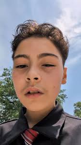 He pet a cat then rubbed his eyes. Allergy attack! #catlover