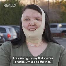 The AMAZING reshaping of Tony's nose from pear-shaped to its original  GOD-GIVEN original shape 🤩 #DrPimplePopper