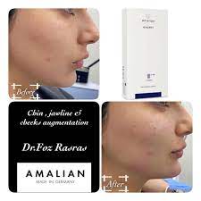 Promo price on until july 15th 2020. Amalian Dermal Fillers Home Facebook