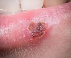 Image result for syphilis ulcer