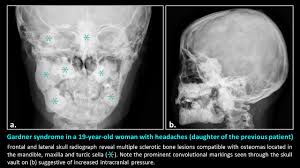 Image result for Gardner Sendromu