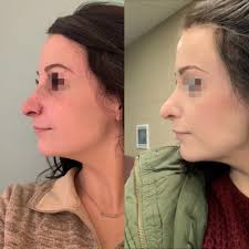 Rhinoplasty