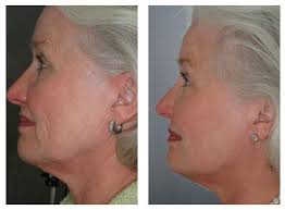 Before and After: CryoFrequency Skin Tightening
