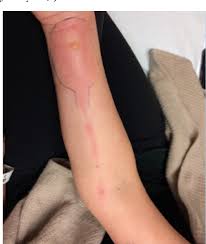 Image result for Nodular Lymphangitis