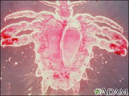 Image result for pubic lice symptoms