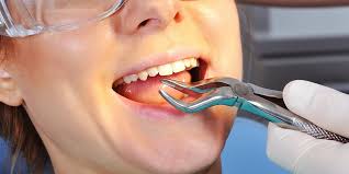 Image result for Alveolitis sicca)