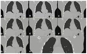 Has been added to your cart. Algorithms Free Full Text Image Resolution Enhancement Of Highly Compressively Sensed Ct Pet Signals Html