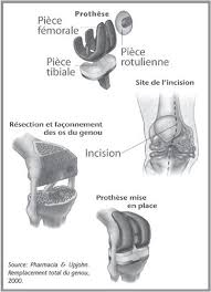 Institut du mouvement et l'appareil locomoteur. Prothese Totale Du Genou Ptg Chu De Quebec Universite Laval