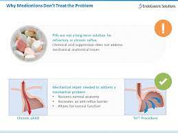 Gastroesophageal reflux (gerd) occurs when stomach acid flows back into the esophagus (the tube connecting your mouth and stomach). Ø§Ø«Ø§Ø± Ù†Ø§Ø¦Ø¨ Ù…ØµØ¯Ø± Ø£Ø¯ÙˆÙŠØ© Gerd Virelaine Org