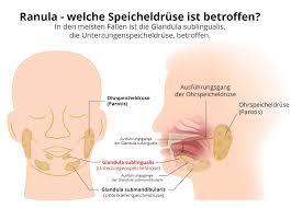 Dabei ist sie wie ein spiegel unserer gesundheit. Froschleingeschwulst Ranula Ursachen Therapie Prognose