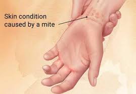 Image result for human scabies