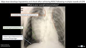 Image result for Open Pneumothorax