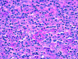 Amira m elbendary, mbbch, msc; Angioimmunoblastic T Cell Lymphoma Dermnet Nz
