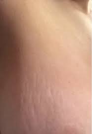 A few days ago i found a dimple under my left breast. To Think This Is A Symptom Of Breast Cancer Picture Mumsnet