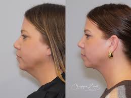 Goodbye double chin, hello jawline! 💁‍♀️ ⏳ In just 30 minutes, Dr.  Christopher Ewart makes it quick and easy with liposuction under local  anesthesia that permanently removes stubborn fat—no need for Ozempic!