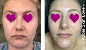 Abbie Skin Love
