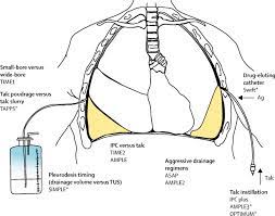 Check spelling or type a new query. Malignant Pleural Effusion Management Keeping The Flood Gates Shut The Lancet Respiratory Medicine