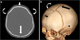 الأشعة قبل خوذة علاج الرأس المسطّح