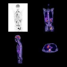 St paul hospital pet scan. Bgn Technologies Introduces Novel Medical Imaging Radioisotope Production Method Daic