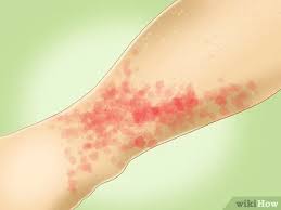 How To Treat Pinpoint Petechiae: 10 Steps (With Pictures)