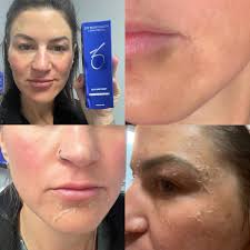 Chemical Peels in Pensacola, FL