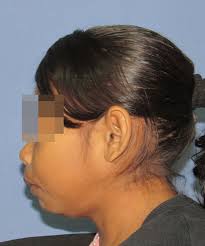 Relationship between dental caries and body mass index in children