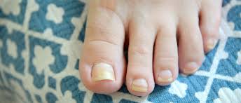 Check spelling or type a new query. Don T Bury Your Toes In The Sand This Summer Tips To Fight Toenail Fungus Lancaster General Health Penn Medicine