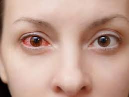 Eye Flu In Delhi-NCR: बाढ़ के बाद अब बढ़ा आई फ्लू का खतरा, सावधानी है बेहद ज़रूरी | TheHealthSite.com हिंदी