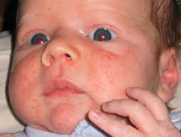 They are caused by hsv type 1 and they are extremely common. Blisters And Pustules In Neonates Dermnet Nz