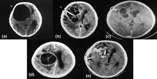 Check spelling or type a new query. Unusual Imaging Characteristics Of Complicated Hydatid Disease European Journal Of Radiology