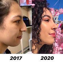 Due to the developing competition plastic surgery clinics in korea offer various additional services included in the final price or provided free of charge to. My Before And After Rhinoplasty Plasticsurgery