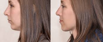 In rare cases, additional orthodontic appliances such as expanders and headgear are needed. What Is An Overbite Deep Overbite Treatment For Adults