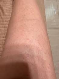 皮膚紅點- 女孩板| Dcard