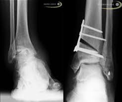 علاج تأكل مفصل الكاحل بالحفاظ على المفصل Orthopaedic Doctor Germany Com
