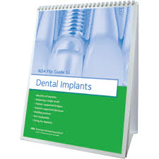 Ada Flip Guide To Dental Implants W483