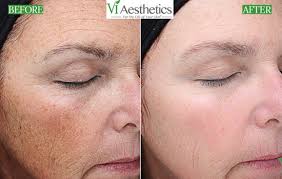 Chemical peels can be applied to the face, hands, and neck. Vi Peel Vis A Vis Day Med Spa